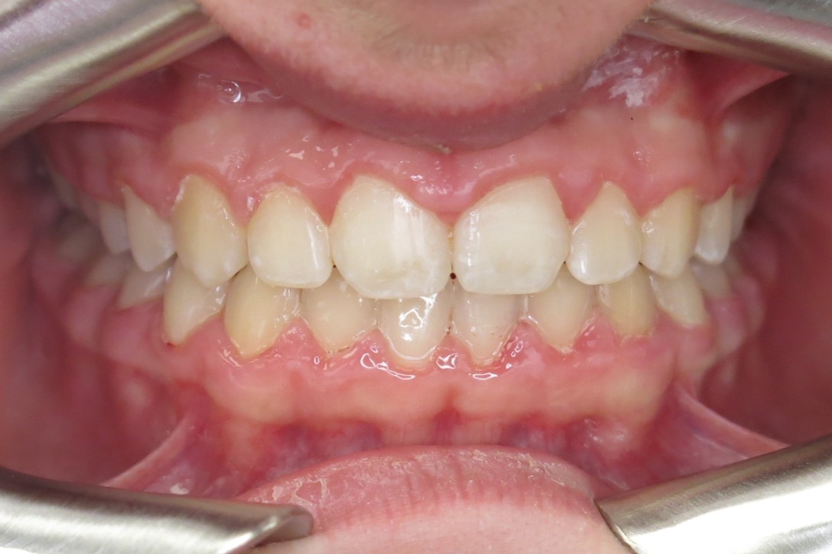 Deep bite corrected — after orthodontic treatment at Smile Studio Orthodontics
