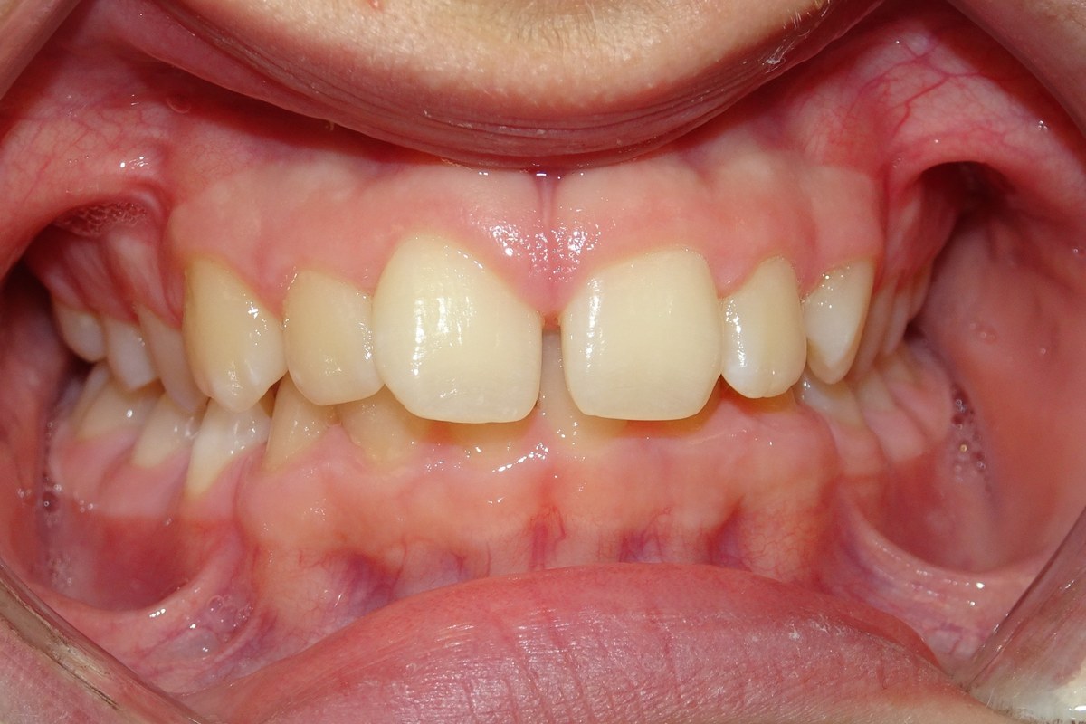 Deep bite corrected — before orthodontic treatment at Smile Studio Orthodontics