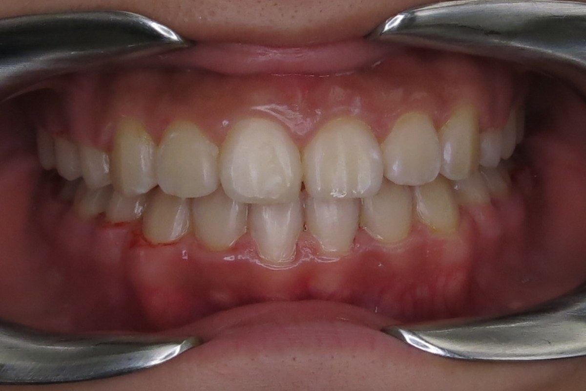 Crowding corrected — after orthodontic treatment at Smile Studio Orthodontics