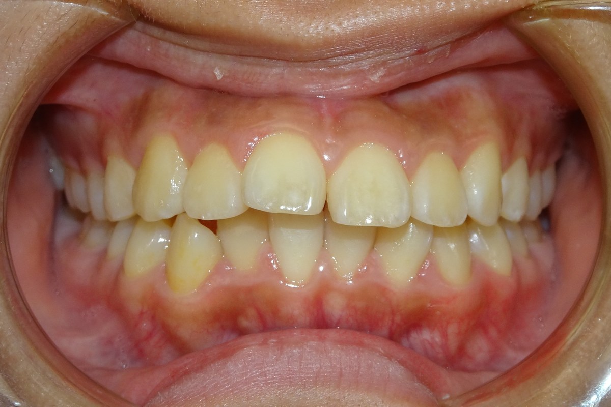 Crowding corrected — before orthodontic treatment at Smile Studio Orthodontics