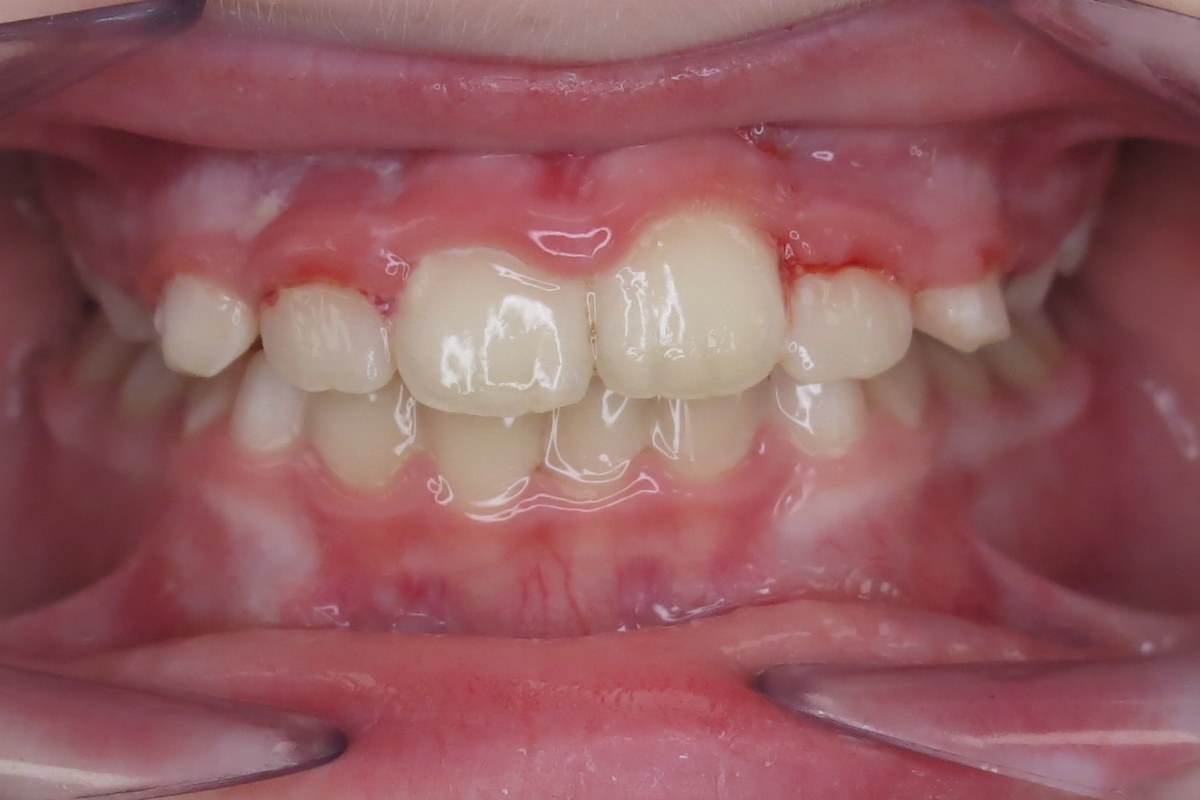 Spacing and protrusion corrected — after orthodontic treatment at Smile Studio Orthodontics