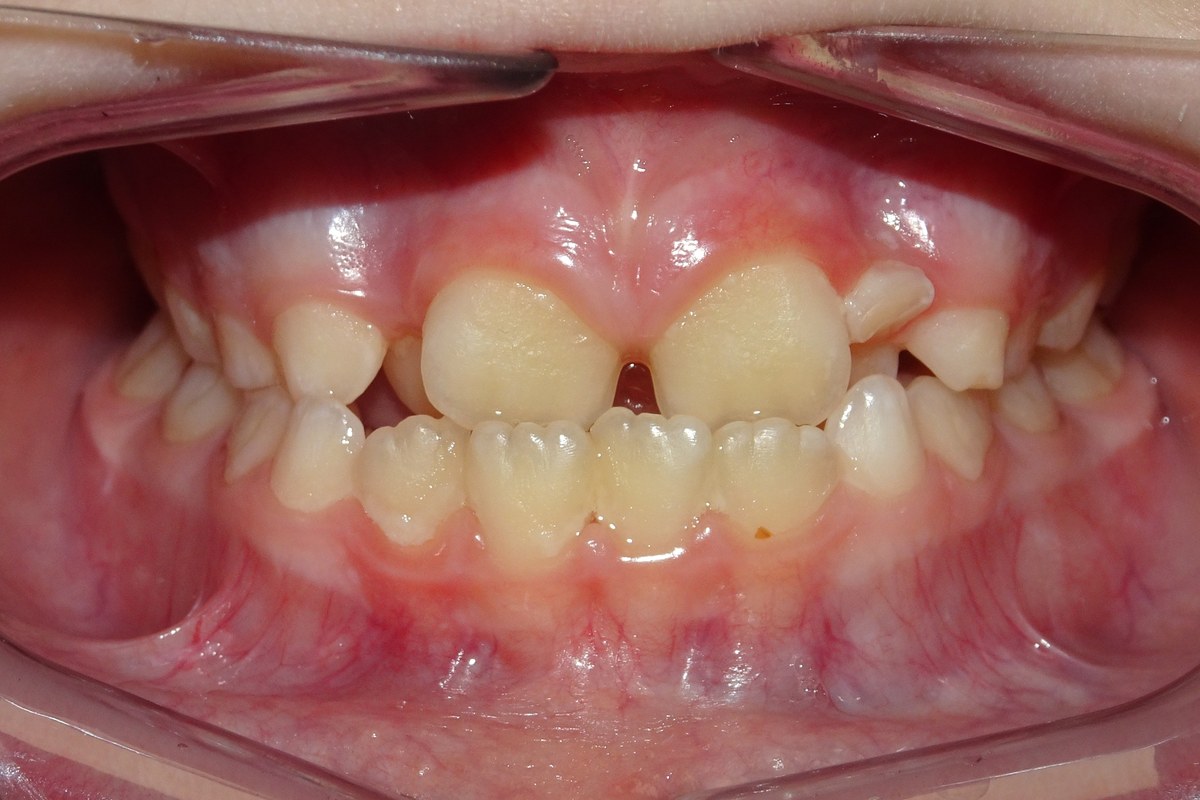 Spacing and protrusion corrected — before orthodontic treatment at Smile Studio Orthodontics