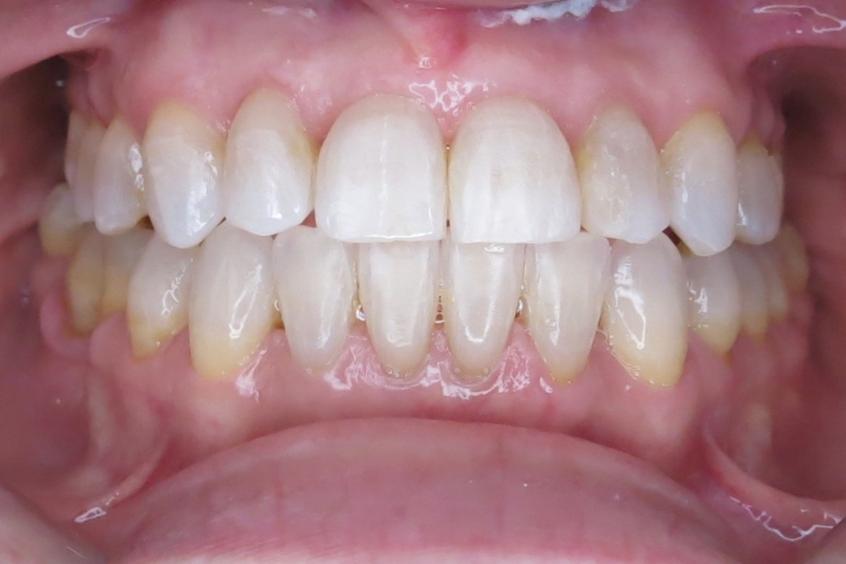 Alignment refined — after orthodontic treatment at Smile Studio Orthodontics