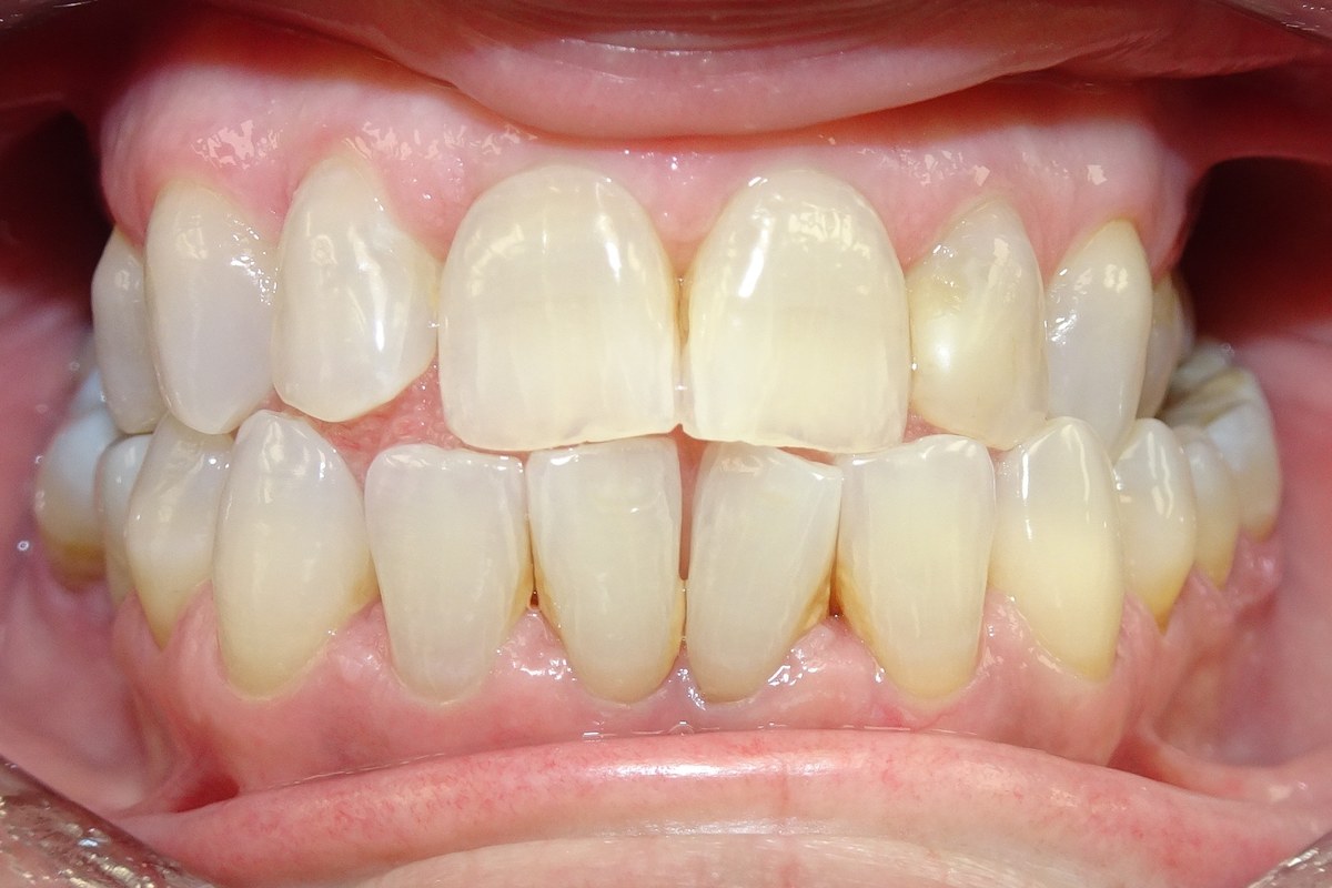Alignment refined — before orthodontic treatment at Smile Studio Orthodontics