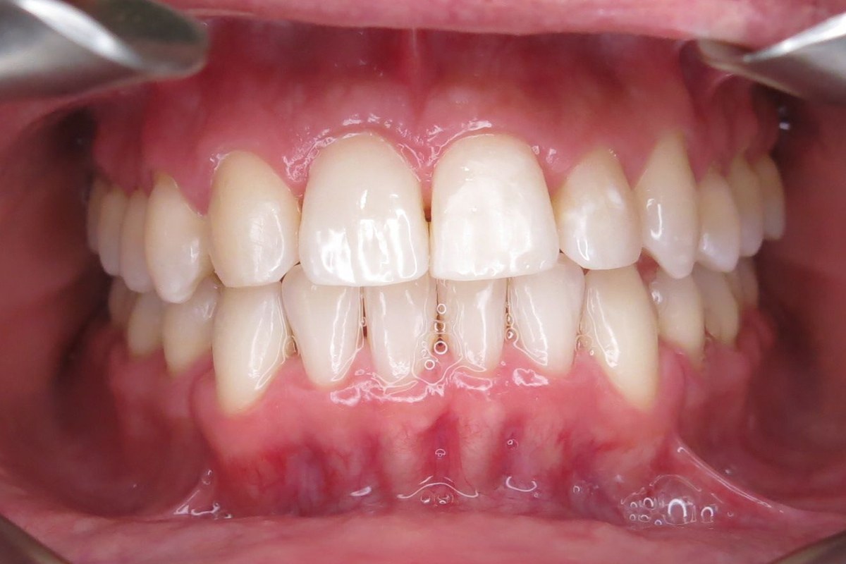 Bite and alignment corrected — after orthodontic treatment at Smile Studio Orthodontics