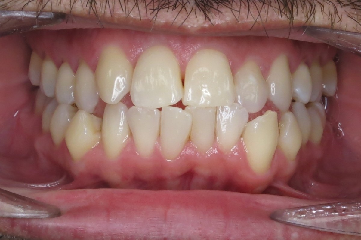 Bite and alignment corrected — before orthodontic treatment at Smile Studio Orthodontics