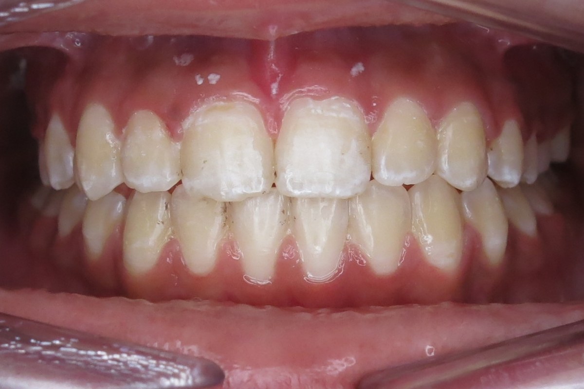 Crowding corrected — after orthodontic treatment at Smile Studio Orthodontics
