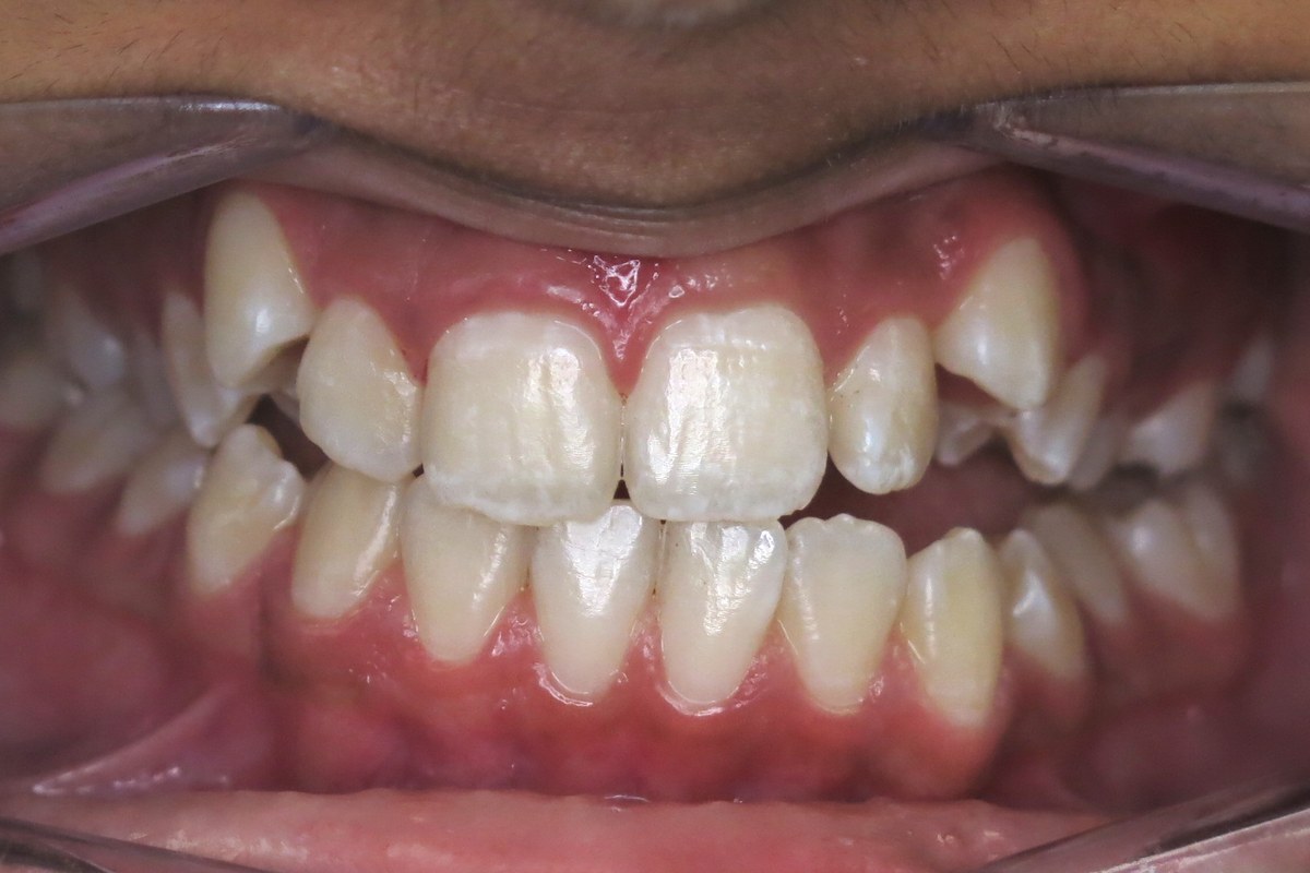 Crowding corrected — before orthodontic treatment at Smile Studio Orthodontics