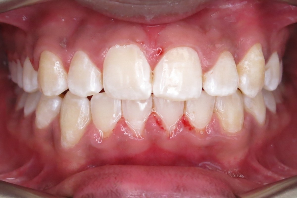 Crowding and rotation corrected — after orthodontic treatment at Smile Studio Orthodontics
