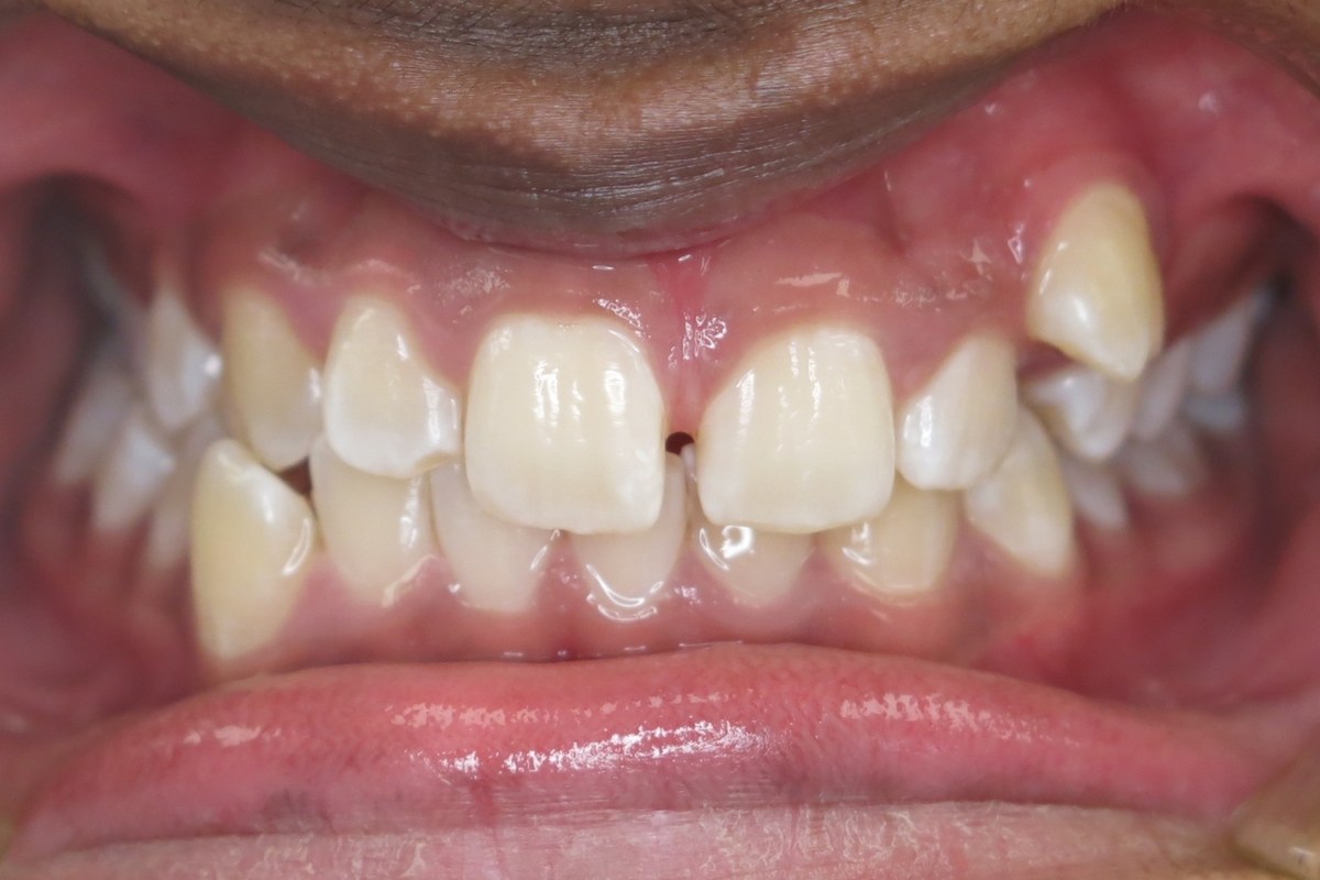Crowding and rotation corrected — before orthodontic treatment at Smile Studio Orthodontics