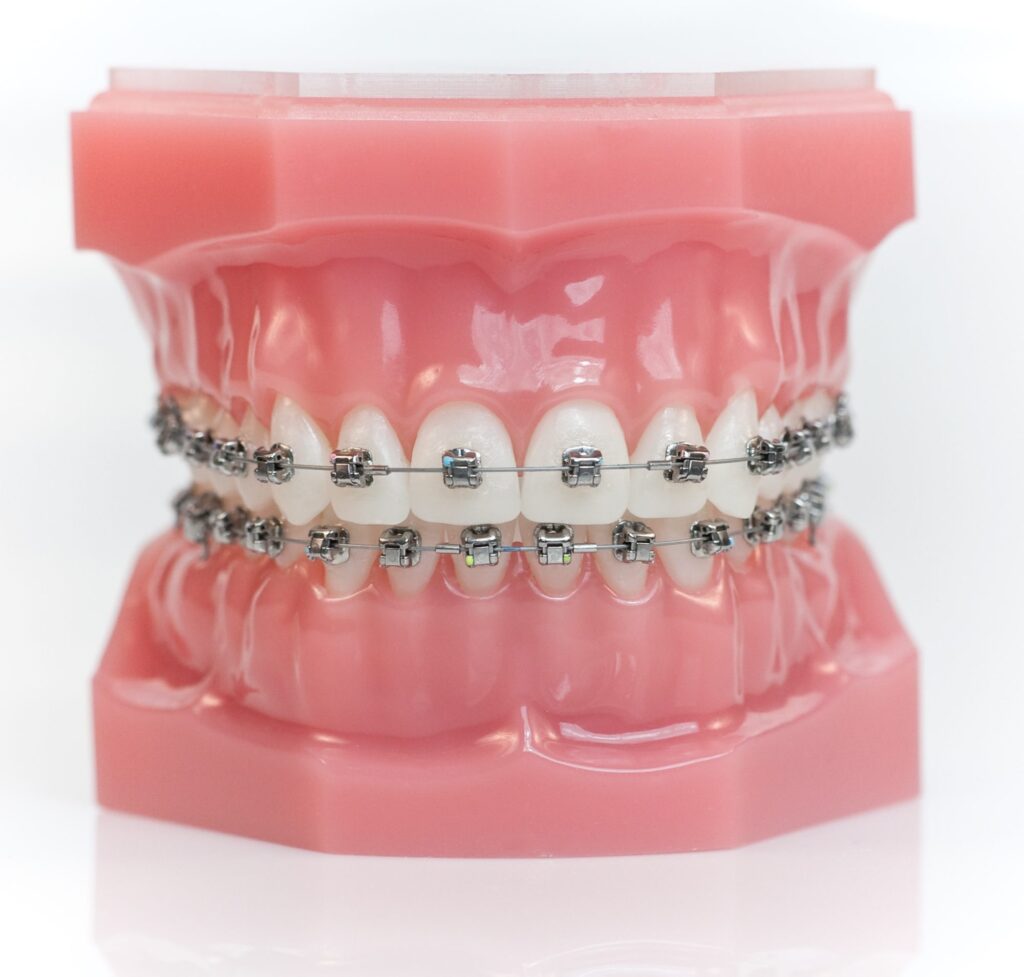 Dental model showing metal braces with brackets and archwires on the upper and lower teeth